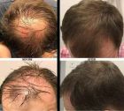 Hair loss treatment